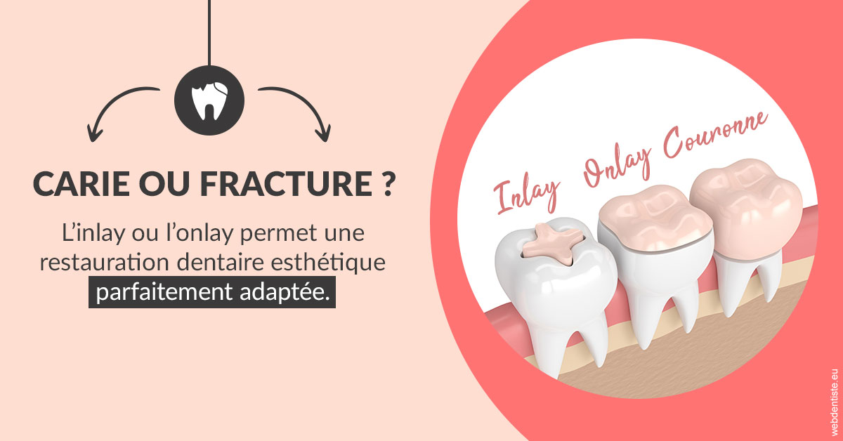 https://selarl-heraud.chirurgiens-dentistes.fr/T2 2023 - Carie ou fracture 2
