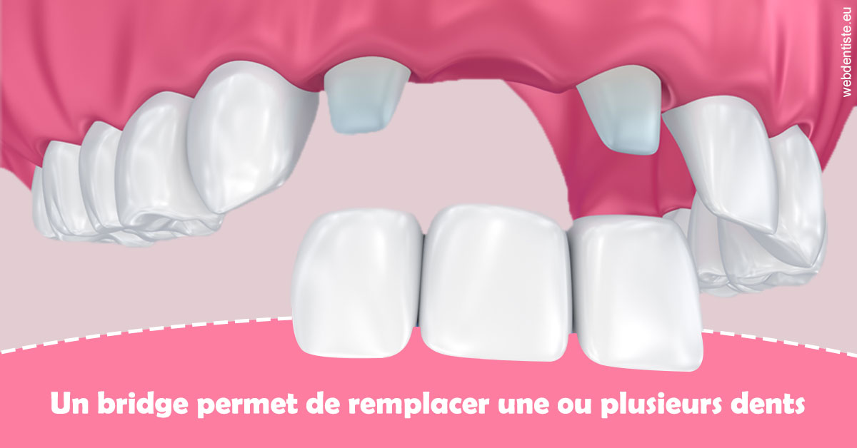 https://selarl-heraud.chirurgiens-dentistes.fr/Bridge remplacer dents 2